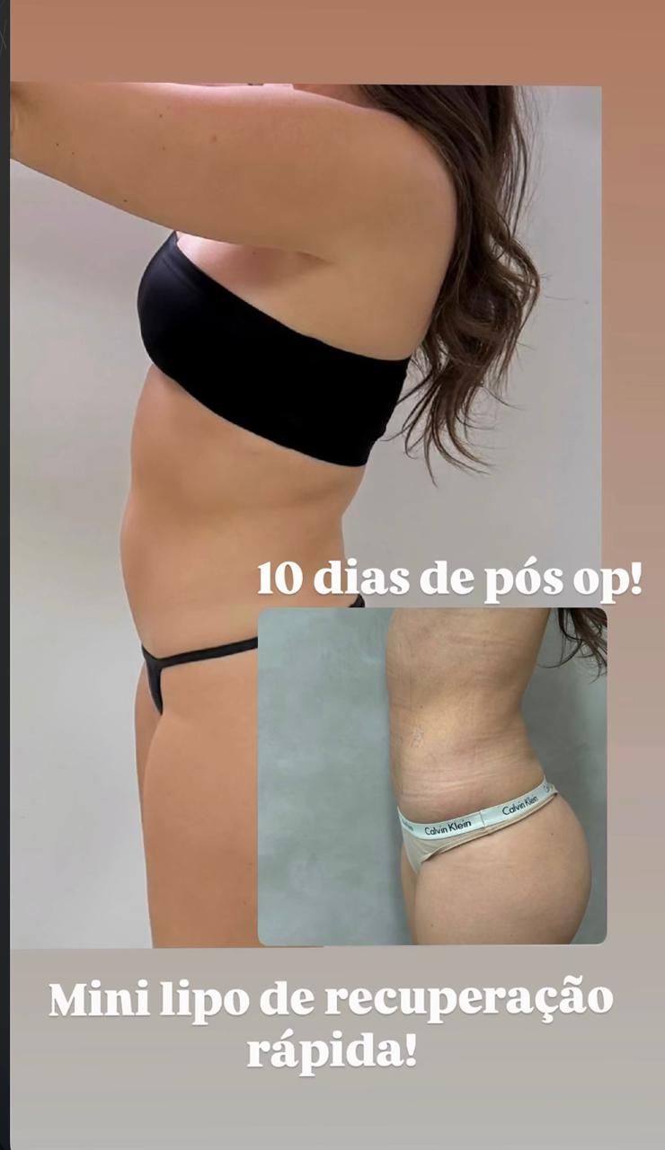 Resultado Mini Lipo - 10 dias pós-operatório